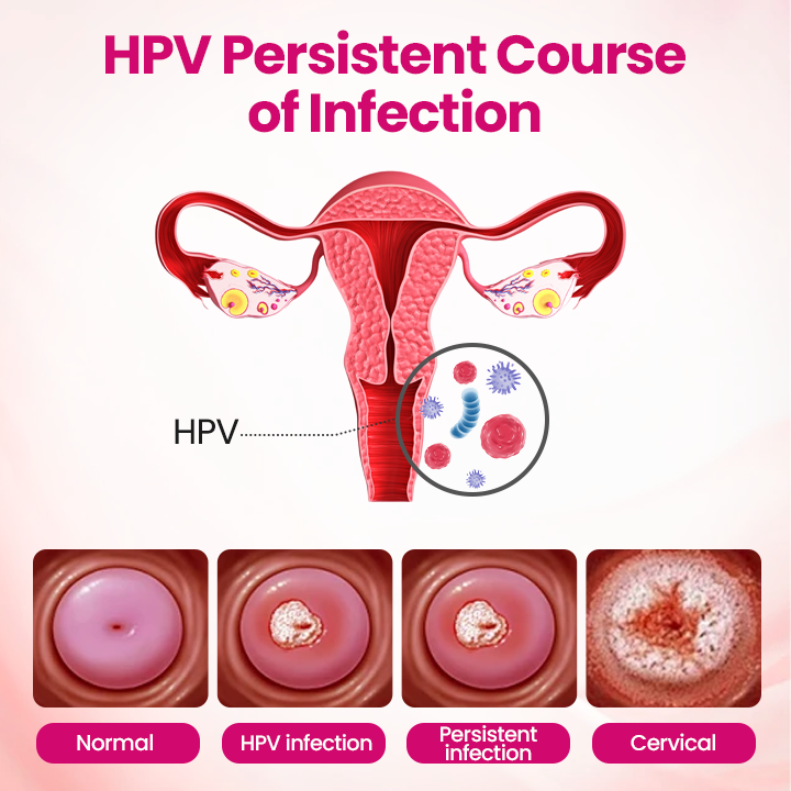 🏆 Breakthrough in Women's Intimate Health! Feel Relief in Just 3 Days with Multi-Targeted HPV Defense